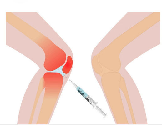 3ml de solução de mesoterapia para dor no joelho ácido hialurônico não reticulado