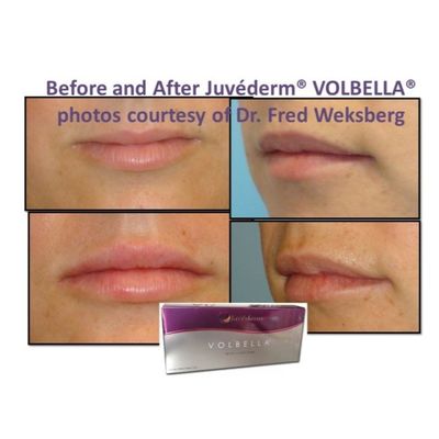Ácido Hialurónico Juvederm Gel de Enchimento Facial Pele Suave e Incompreensível