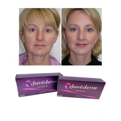 6-9 meses Duração Juvederm Dermal Filler Gel para compra online e em loja