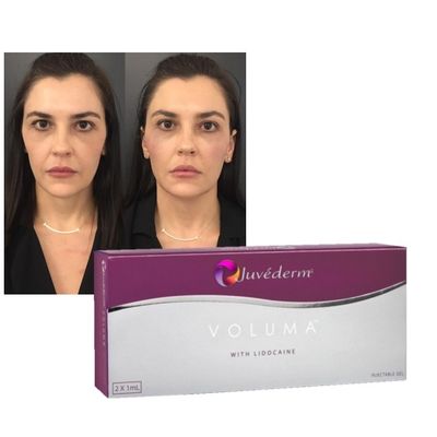 Gel de preenchimento dérmico de ácido hialurônico Juvederm Fórmula para realce de rejuvenescimento de lábios e bochechas