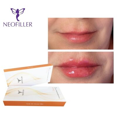 Comprimido Dermológico de Ácido Hyalurónico 24mg-ml Injetável Gel de Melhora de Lábios Rejuvenescimento Facial