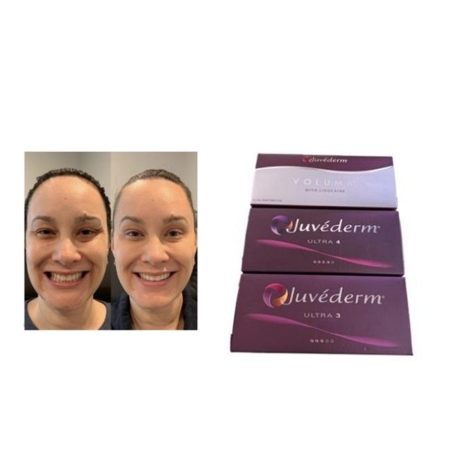 Enchimento Dermológico HA Juvederm Ultra3 Ultra4 Volume de ligação transversal Condições de armazenamento Evitar congelamento Gel injetável para restauração do volume facial