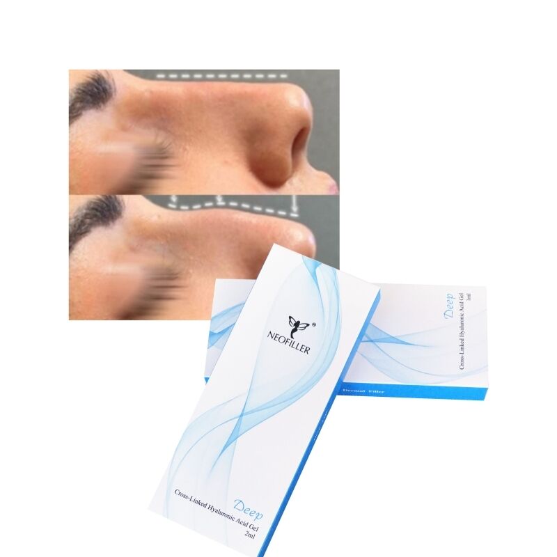 2 ml de Ácido Hialurónico Enchimento Dermológico Linha Profunda Conto do Nariz Gel Injetável Melhoria Facial