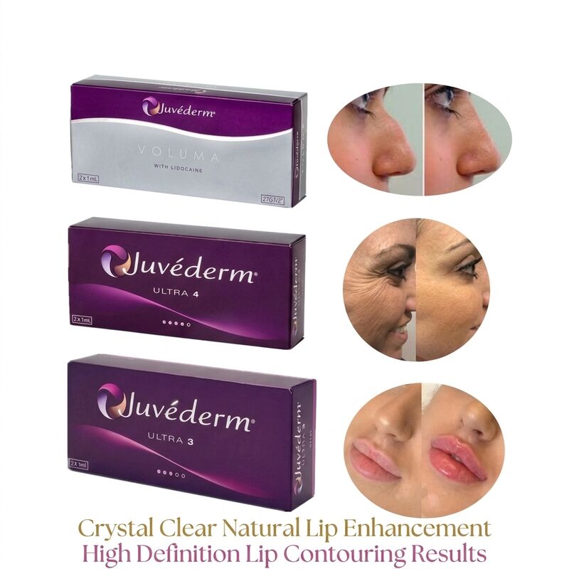 Volume da Seringa 2 1 ml por Caixa Juvederm Voluma Filler Segurança Contouring Facial Injetável Filler Dermico para aumento de volume